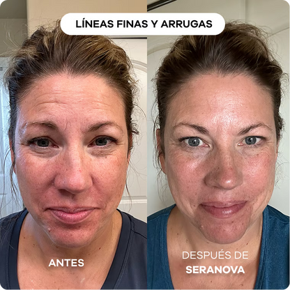 Sistema de Infusión con Microneedling™